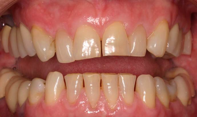 Veneers Case 5 - Before