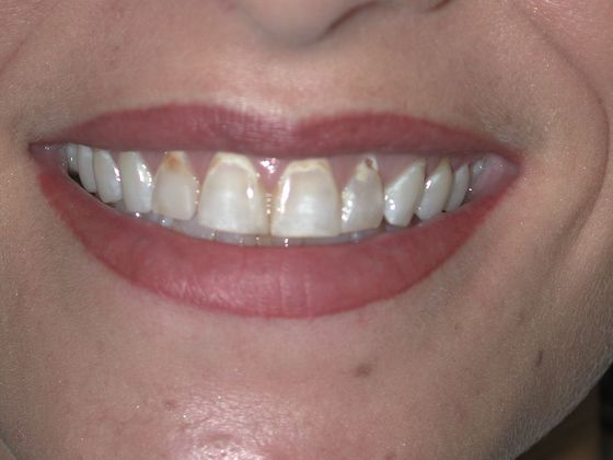 Veneers: Case 1 - before