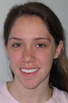 Laminates and Veneers Case 3 - After