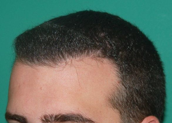 Hair Loss Surgery: 3332 Graft Frontal Hairline Restoration - Postop Left View 1