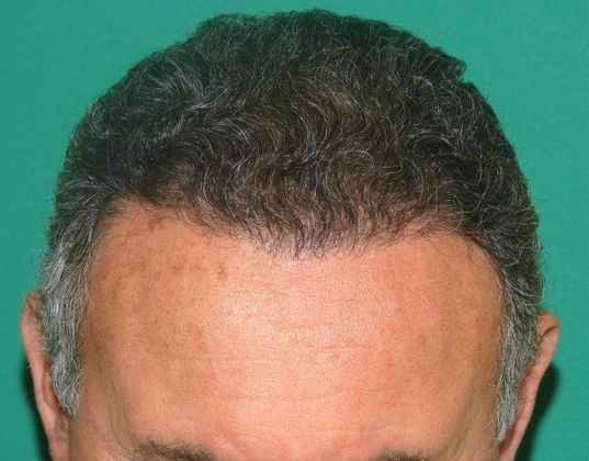 Hair Loss Surgery: 2569 Graft Hairline Restoration - Postop Front 3