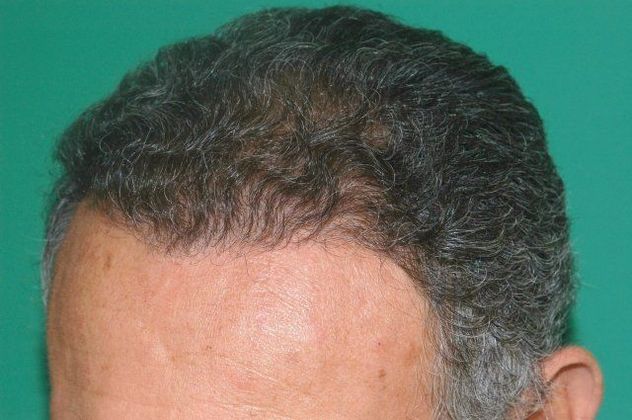 Hair Loss Surgery: 2569 Graft Hairline Restoration - Postop Left 3