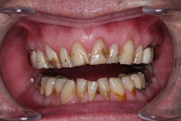 Full Mouth Rehabilitation: Richard - Before