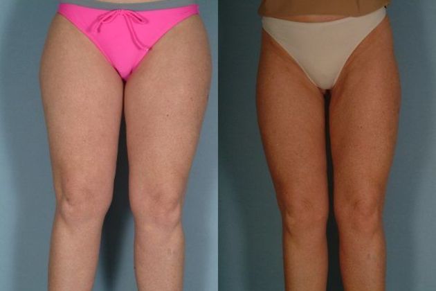 Liposuction Cost Little Rock AR Cost of Liposuction Suzanne