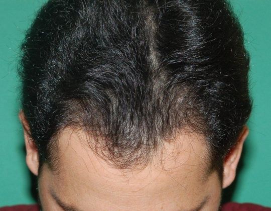 Hair Loss Surgery: 2158 Graft Hairline Restoration - Preop Front
