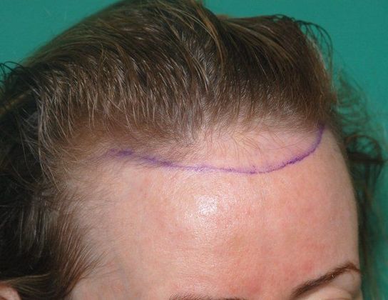 Hair Loss Surgery: 1023 Graft Female Hairline Restoration - Planned Graft Zone Right