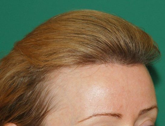 Hair Loss Surgery: 1023 Graft Female Hairline Restoration - Postop Right 2