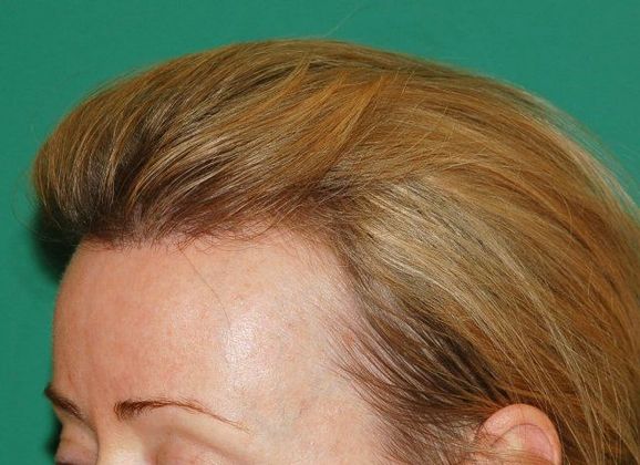 Hair Loss Surgery: 1023 Graft Female Hairline Restoration - Postop Left 3
