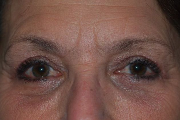 Ptosis Repair Case 6 - After