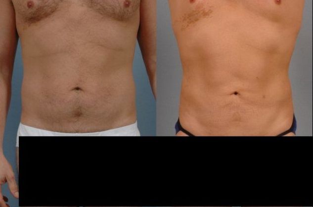 Case 2 - Liposuction - Before And After Gallery