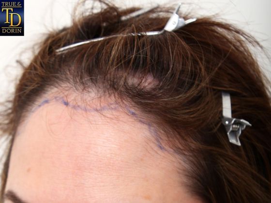 Hair Transplant - Female: Healing Series - Before