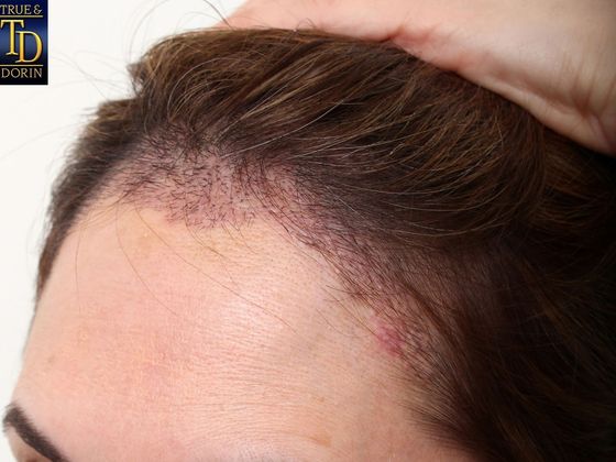 Hair Transplant - Female: Healing Series - Post-op 11 days after female hair translplant