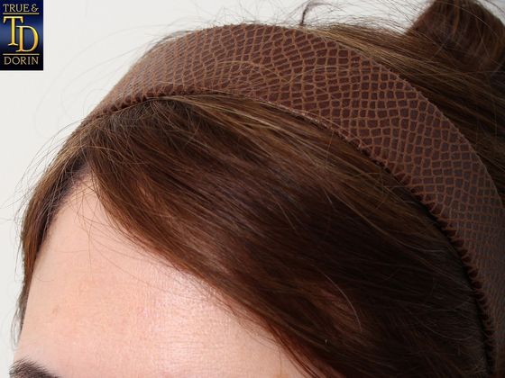 Hair Transplant - Female: Healing Series - Post-op 11 days female hair transplant - Covered