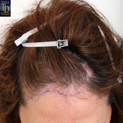 Hair Transplant - Female: Healing Series - Before female hair transplant