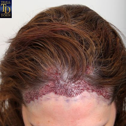 Hair Transplant - Female: Healing Series - Post-op surgery day female hair transplant