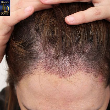 Hair Transplant - Female: Healing Series - Post-op 11 days after female hair translplant