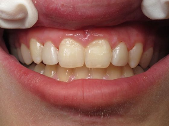 Porcelain Veneers Case 4 - After