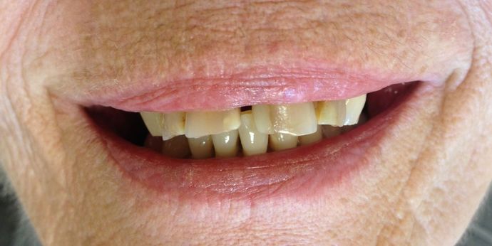 Dentures Patient # 2 - Before