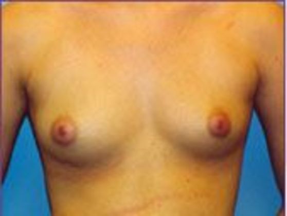 Breast Augmentation: Case 2 - BEFORE