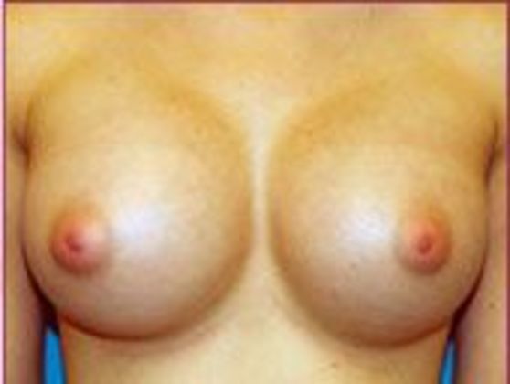 Breast Augmentation: Case 2 - AFTER