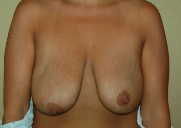 Breast Augmentation w/ Lift: Case 61 - Before