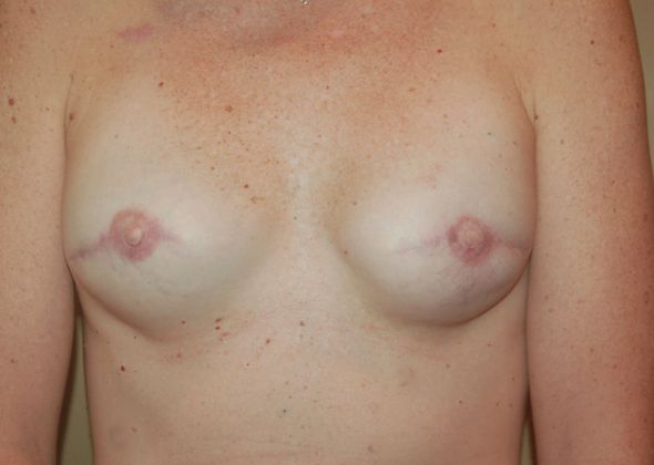 Breast Reconstruction Case 27 - After