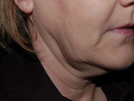 Facelift: Case 7 - Before