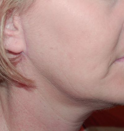 Facelift: Case 7 - After