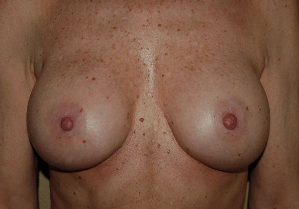 Breast Revision: Case 4 - After