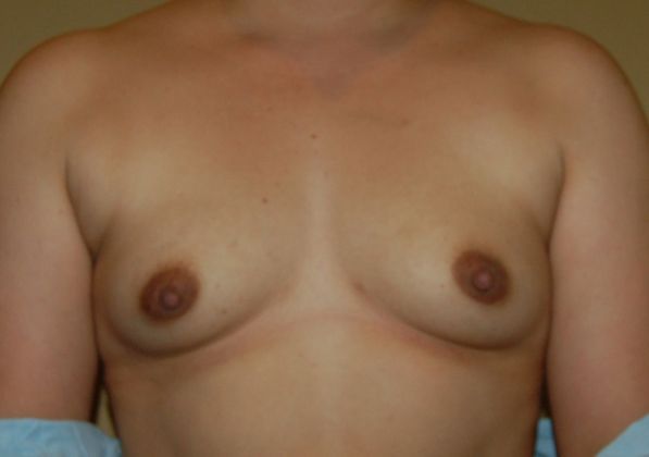 Breast Augmentation Case 138 - Before