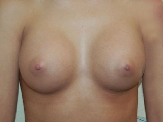 Breast Augmentation Case 140 - After