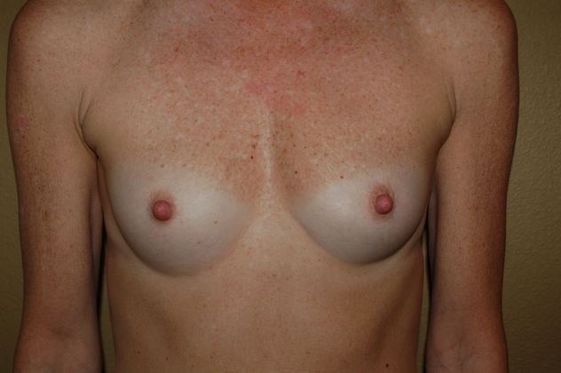 Breast Augmentation Case 144 - Before