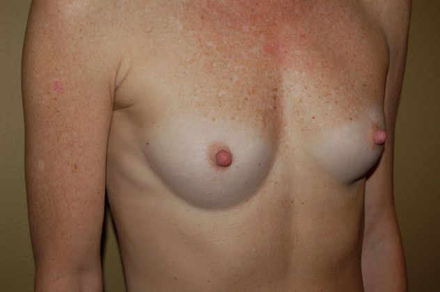 Breast Augmentation: Case 144 - Before