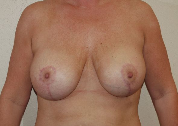 Breast Revision: Case 5 - After