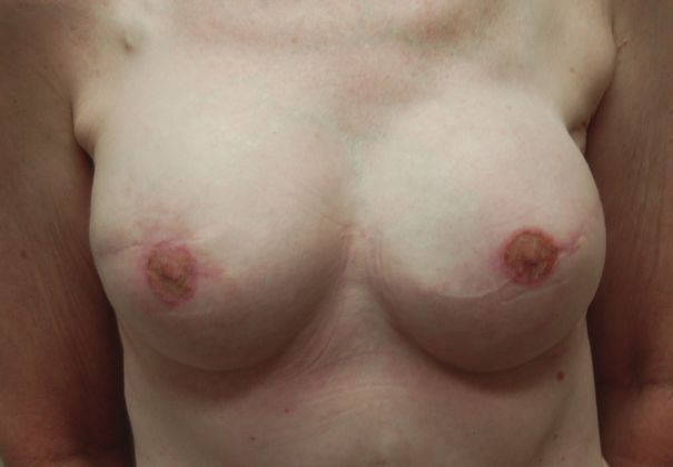 Breast Reconstruction Case 30 - After
