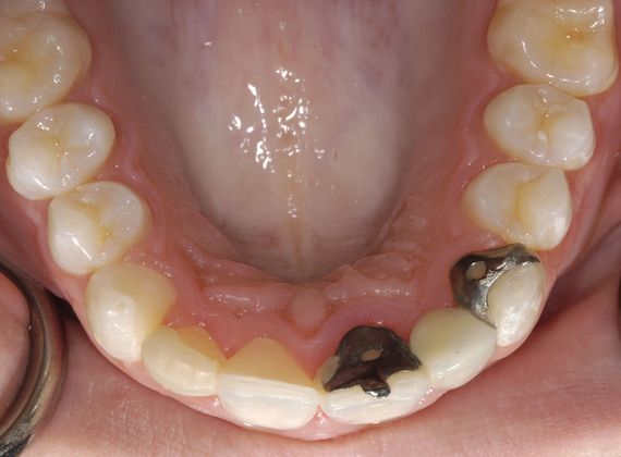 Porcelain Veneers/Crown Combination: Porcelain Veneer/Crown Combination - Before Lingual View