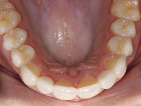 Porcelain Veneers/Crown Combination: Porcelain Veneer/Crown Combination - After Lingual View