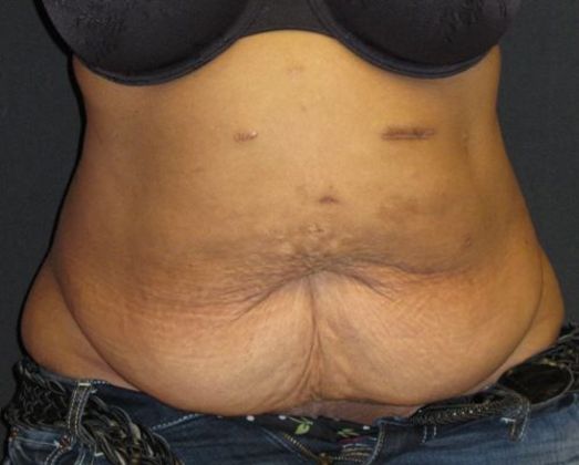 Abdominoplasty: Case 8 - before