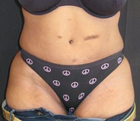 Abdominoplasty: Case 8 - easily hidden scar