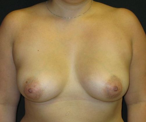 Breast Augmentation Case 12 - After
