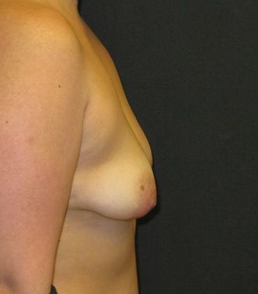 Breast Augmentation: Case 12 - before