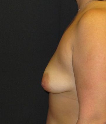 Breast Augmentation: Case 12 - before