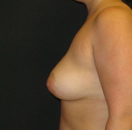 Breast Augmentation: Case 12 - after 3 months