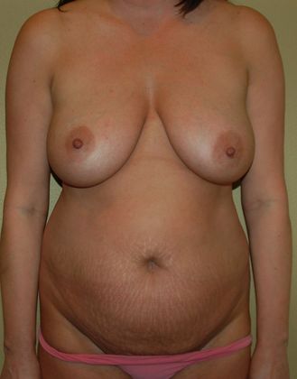 Mommy Makeover Case 28 - Before