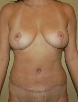 Mommy Makeover Case 28 - After