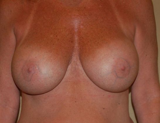 Breast Revision: Case 8 - After