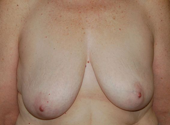Breast Augmentation w/ Lift Case 64 - Before