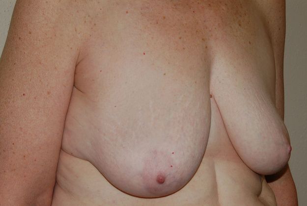 Breast Augmentation w/ Lift: Case 64 - Before
