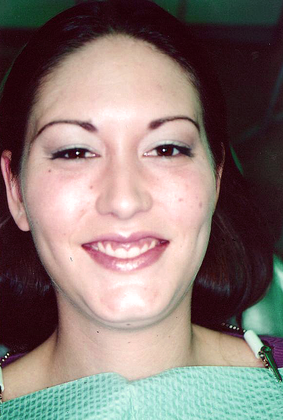 Gum Lift: Case 1 - Before