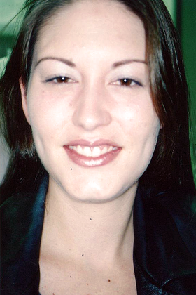 Gum Lift: Case 1 - After